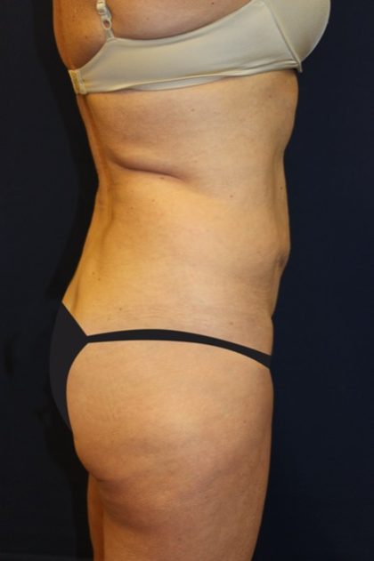 Tummy Tuck Before & After Patient #2932