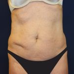 Tummy Tuck Before & After Patient #2932