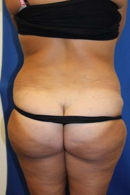 Tummy Tuck Before & After Patient #2901