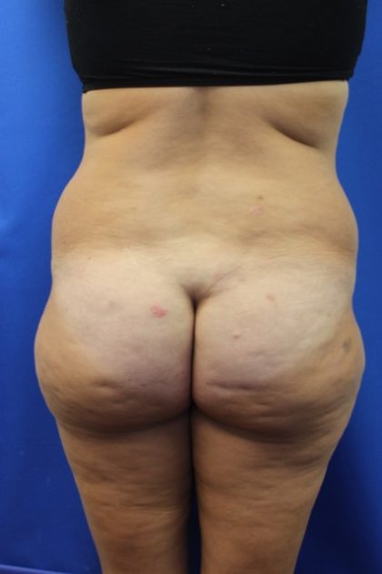 Tummy Tuck Before & After Patient #2901