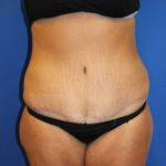 Tummy Tuck Before & After Patient #2901