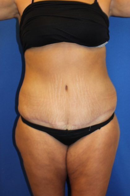 Tummy Tuck Before & After Patient #2901