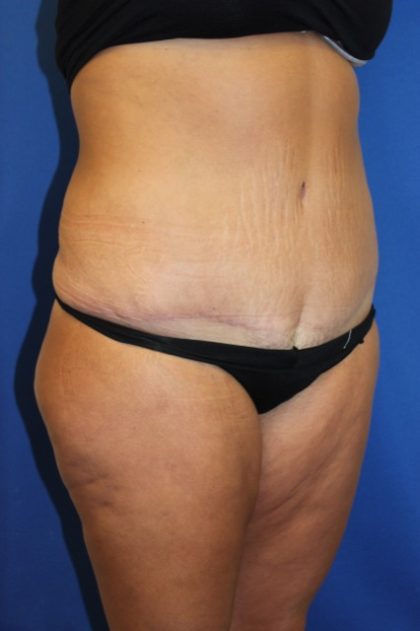 Tummy Tuck Before & After Patient #2901