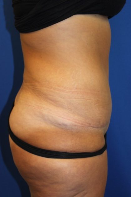 Tummy Tuck Before & After Patient #2901