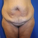 Tummy Tuck Before & After Patient #2901
