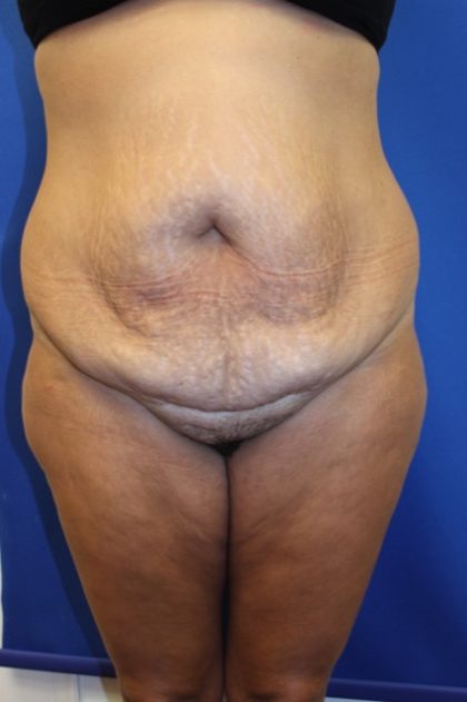 Tummy Tuck Before & After Patient #2901