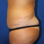 Tummy Tuck Before & After Patient #2901