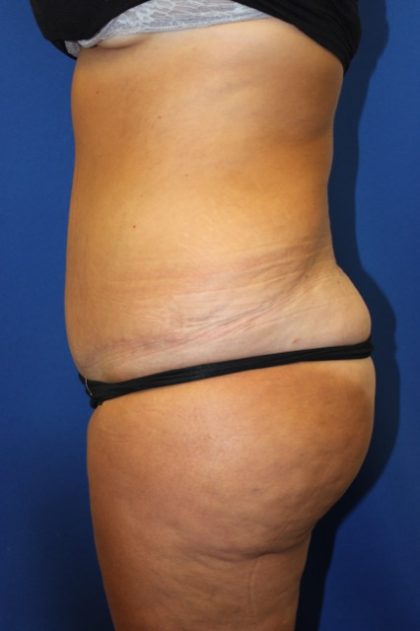 Tummy Tuck Before & After Patient #2901