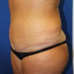 Tummy Tuck Before & After Patient #2901