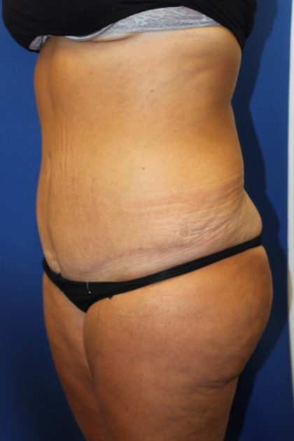 Tummy Tuck Before & After Patient #2901