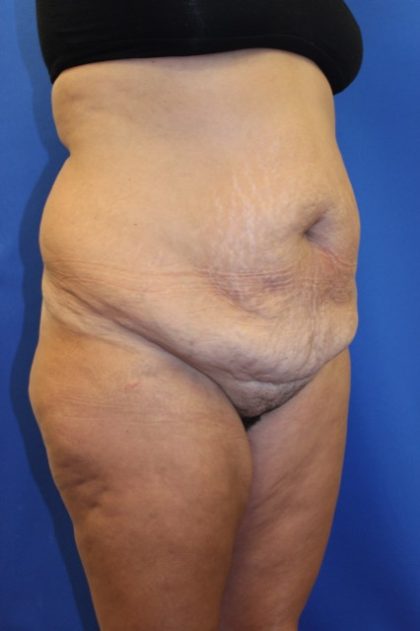 Tummy Tuck Before & After Patient #2901