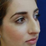 Rhinoplasty Before & After Patient #3451