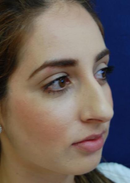 Rhinoplasty Before & After Patient #3451