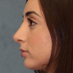 Rhinoplasty Before & After Patient #3451