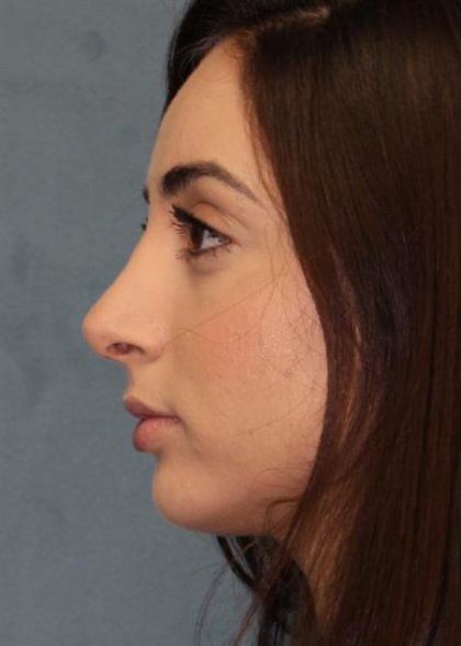 Rhinoplasty Before & After Patient #3451