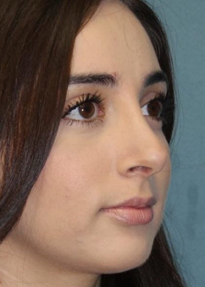 Rhinoplasty Before & After Patient #3451