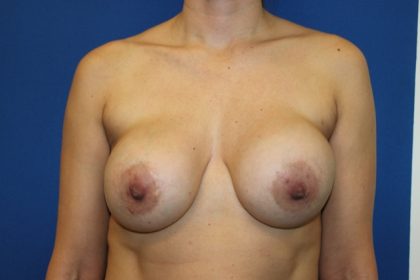 Breast Revision Before & After Patient #2610
