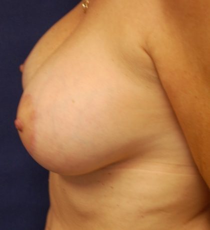 Breast Augmentation Before & After Patient #2077