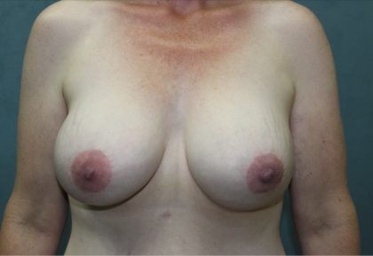 Breast Augmentation Before & After Patient #2066