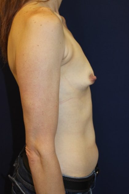 Breast Augmentation Before & After Patient #2084