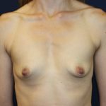 Breast Augmentation Before & After Patient #2084