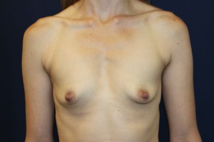 Breast Augmentation Before & After Patient #2084