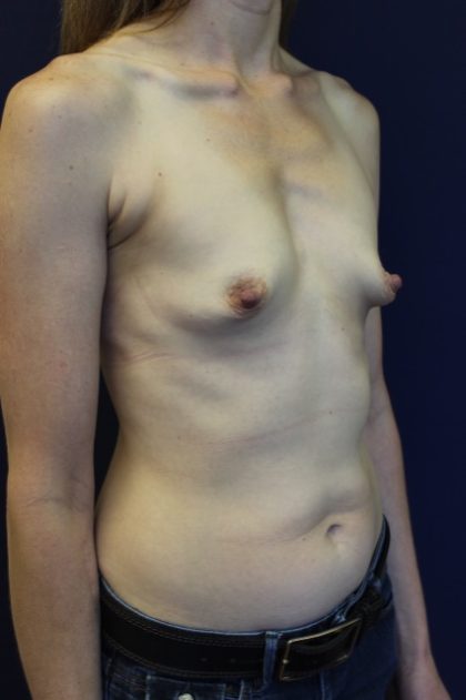 Breast Augmentation Before & After Patient #2084