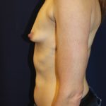 Breast Augmentation Before & After Patient #2084