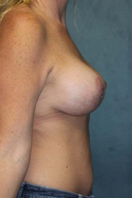 Breast Augmentation Before & After Patient #1986