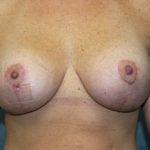 Breast Augmentation Before & After Patient #1986