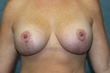 Breast Augmentation Before & After Patient #1986