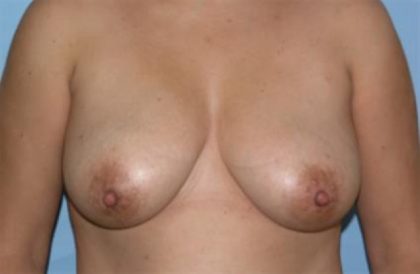 Breast Augmentation Before & After Patient #1981