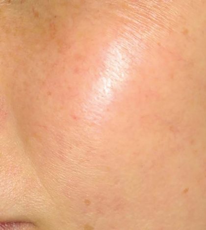 Laser Treatments Before & After Patient #3296