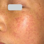 Laser Treatments Before & After Patient #3296