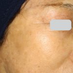 Laser Treatments Before & After Patient #3296