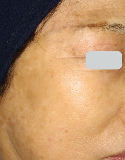 Laser Treatments Before & After Patient #3296