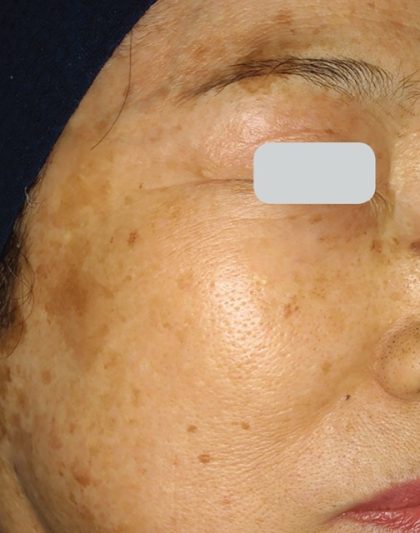 Laser Treatments Before & After Patient #3296