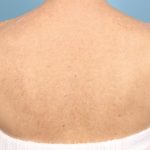 Laser Treatments Before & After Patient #3281