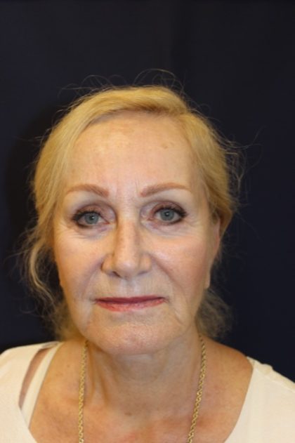 Hair Restoration Before & After Patient #3229