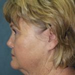 Facelift Before & After Patient #2806