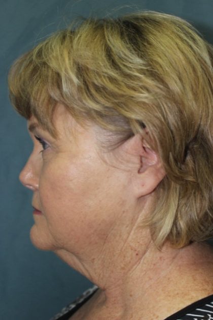 Facelift Before & After Patient #2806