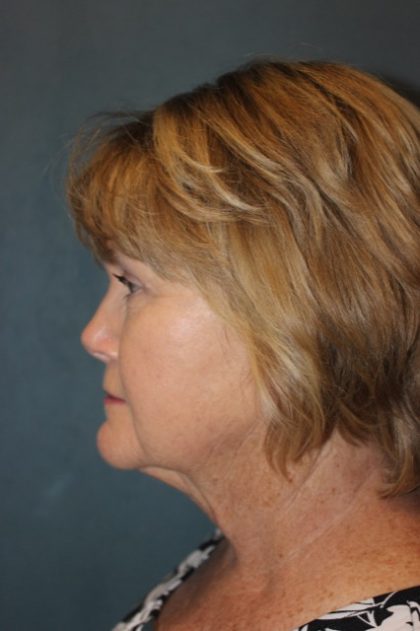 Facelift Before & After Patient #2806