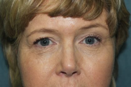 Facelift Before & After Patient #2806