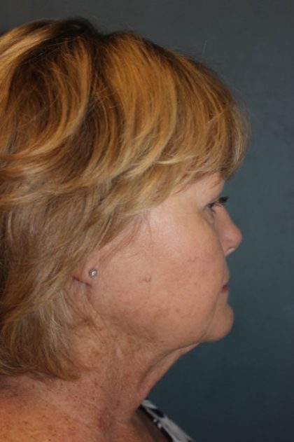 Facelift Before & After Patient #2806