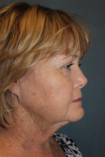 Facelift Before & After Patient #2806