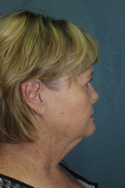 Facelift Before & After Patient #2806