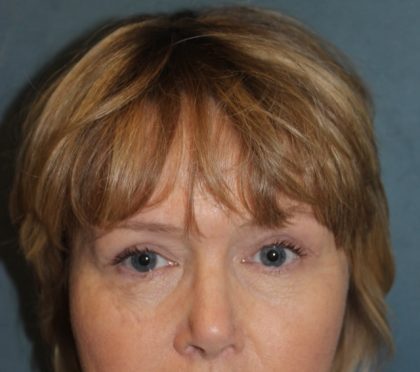 Facelift Before & After Patient #2806