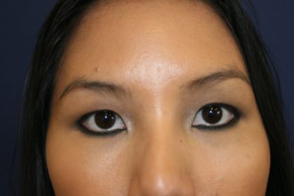 Blepharoplasty Before & After Patient #2761