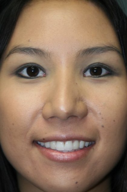 Blepharoplasty Before & After Patient #2761