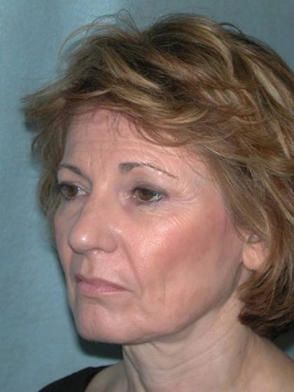 Blepharoplasty Before & After Patient #2788